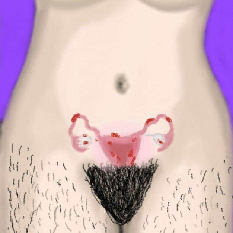 Ilustración del abdómen y pelvis de una mujer, incluyendo el útero lastimado. 